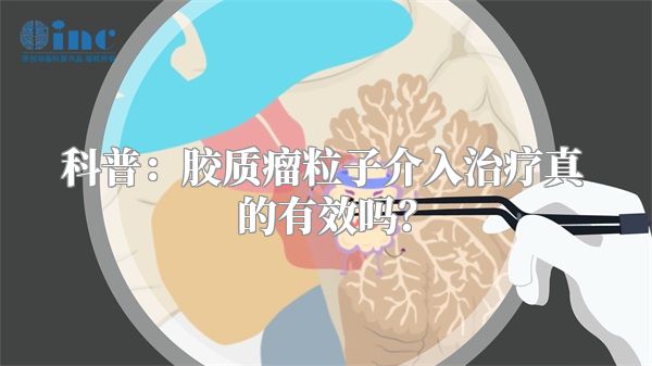 科普：胶质瘤粒子介入治疗真的有效吗？