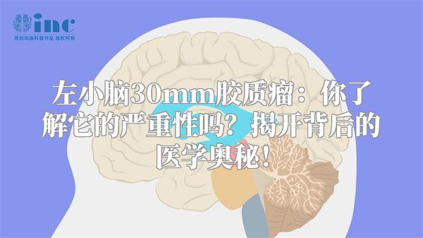 左小脑30mm胶质瘤：你了解它的严重性吗？揭开背后的医学奥秘！