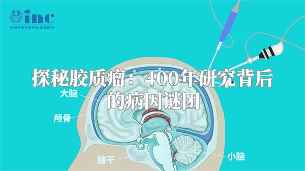 探秘胶质瘤：400年研究背后的病因谜团