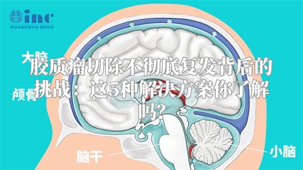 胶质瘤切除不彻底复发背后的挑战：这5种解决方案你了解吗？