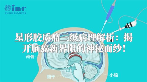 星形胶质瘤三级病理解析：揭开脑癌新界限的神秘面纱！