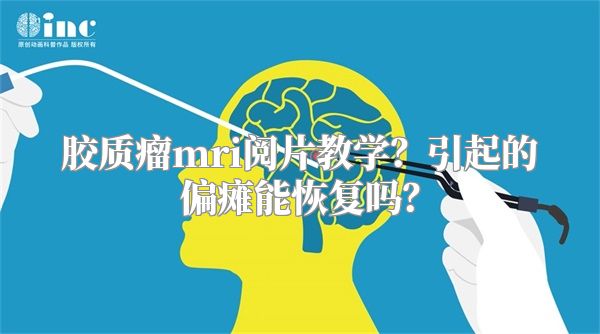 胶质瘤mri阅片教学？引起的偏瘫能恢复吗？