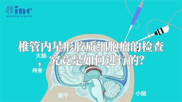 椎管内星形胶质细胞瘤的检查，究竟是如何进行的？