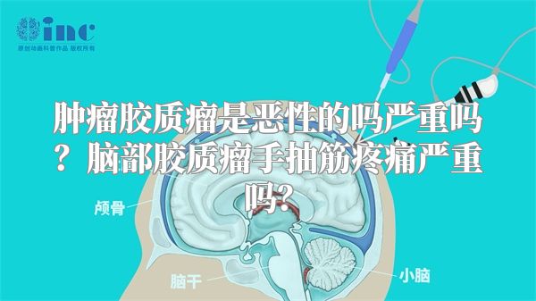 肿瘤胶质瘤是恶性的吗严重吗？脑部胶质瘤手抽筋疼痛严重吗？