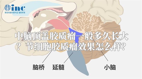 中脑顶盖胶质瘤一般多久长大？节细胞胶质瘤效果怎么样？