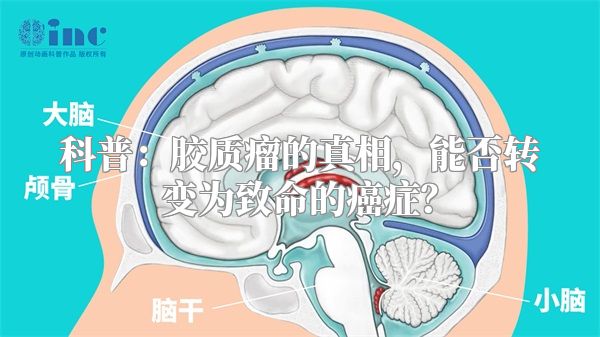 科普：胶质瘤的真相，能否转变为致命的癌症？