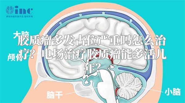 胶质瘤多发占位严重吗怎么治疗？电场治疗胶质瘤能多活几年？