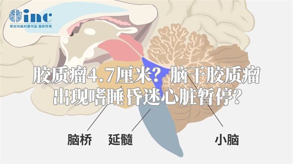 胶质瘤4.7厘米？脑干胶质瘤出现嗜睡昏迷心脏暂停？