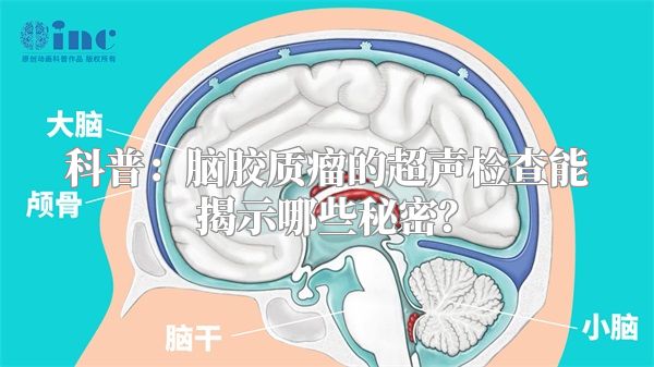 科普：脑胶质瘤的超声检查能揭示哪些秘密？