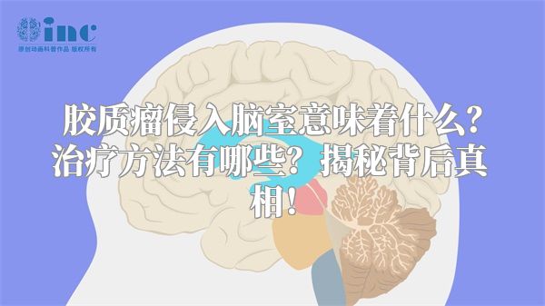 胶质瘤侵入脑室意味着什么？治疗方法有哪些？揭秘背后真相！