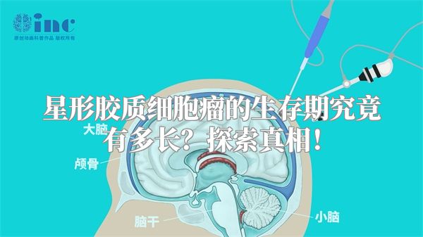 星形胶质细胞瘤的生存期究竟有多长？探索真相！