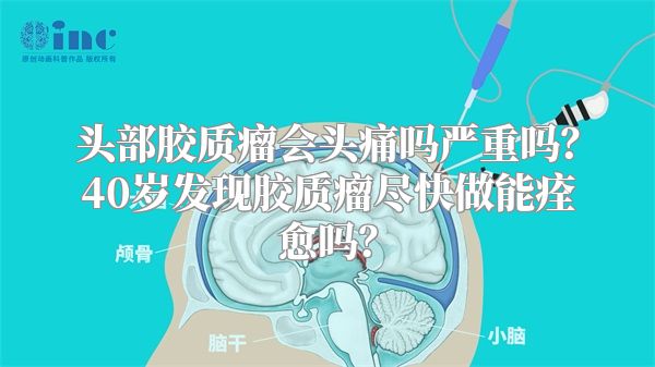 头部胶质瘤会头痛吗严重吗？40岁发现胶质瘤尽快做能痊愈吗？