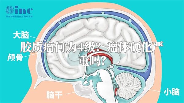 胶质瘤何为4级？瘤体硬化严重吗？