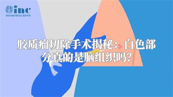 胶质瘤切除手术揭秘：白色部分真的是脑组织吗？