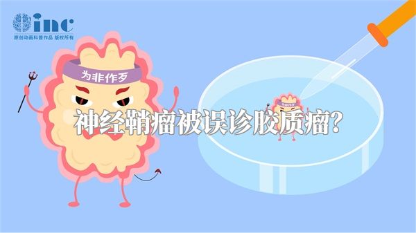 神经鞘瘤被误诊胶质瘤?