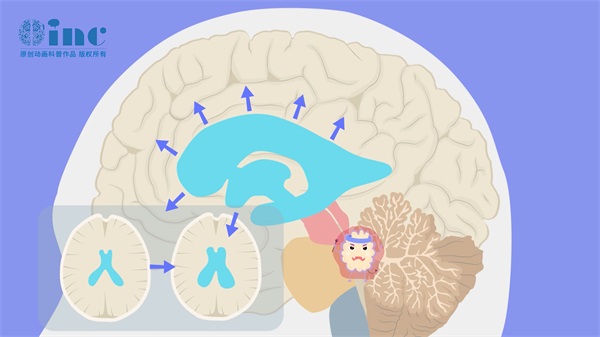 脑干胶质瘤疯狂生长怎么办?复发还能治疗吗?