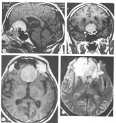 嗅沟脑膜瘤的外科手术治疗