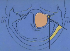 听神经瘤是大手术吗？听神经瘤枕下入路详细描述